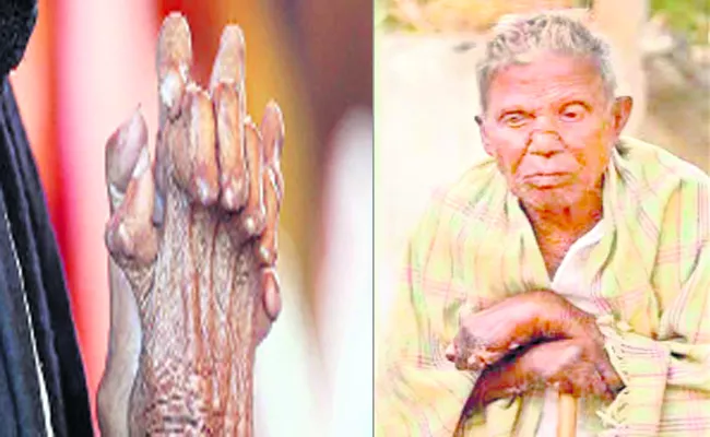 Leprosy Disease  Villages In Adilabad - Sakshi