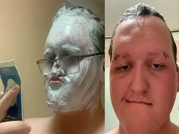 Australia Man Applied Hair Removal Mistaking That A Shaving Cream - Sakshi