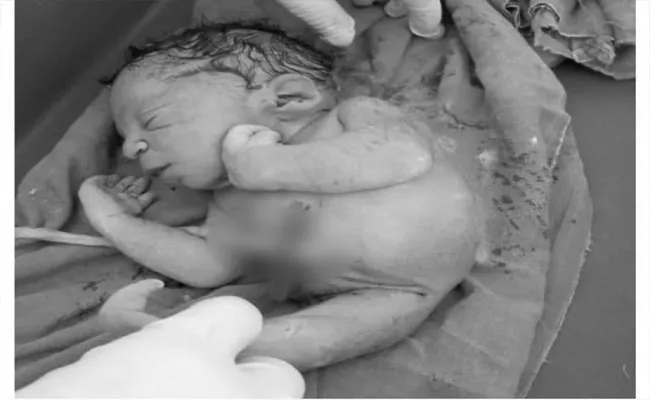 Baby Born With One Leg  Born In karnataka - Sakshi
