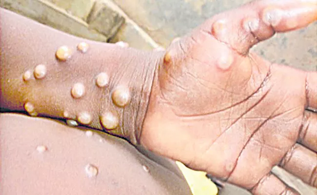 Multi-country monkeypox outbreak in non-endemic countries - Sakshi