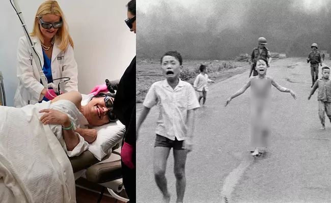 Napalm Girl Gets Final Skin Treatment 50 years Later - Sakshi