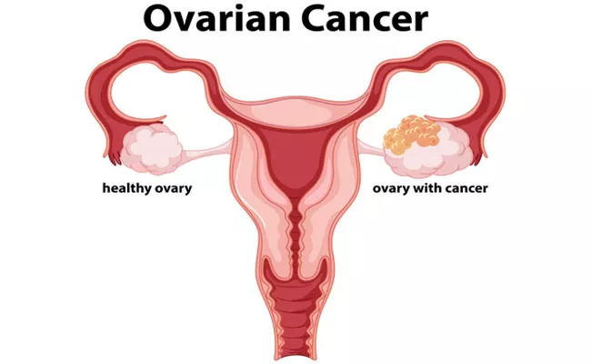 Symptoms And Treatment For Ovarian Cancer In Ladies - Sakshi