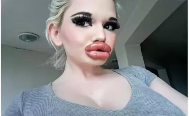 The Bulgarian Woman Spent Rs 20 Lakh To Get The Worlds Biggest Lips - Sakshi